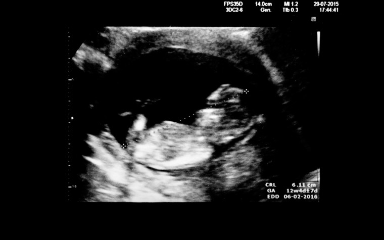 How early can i do a dating scan